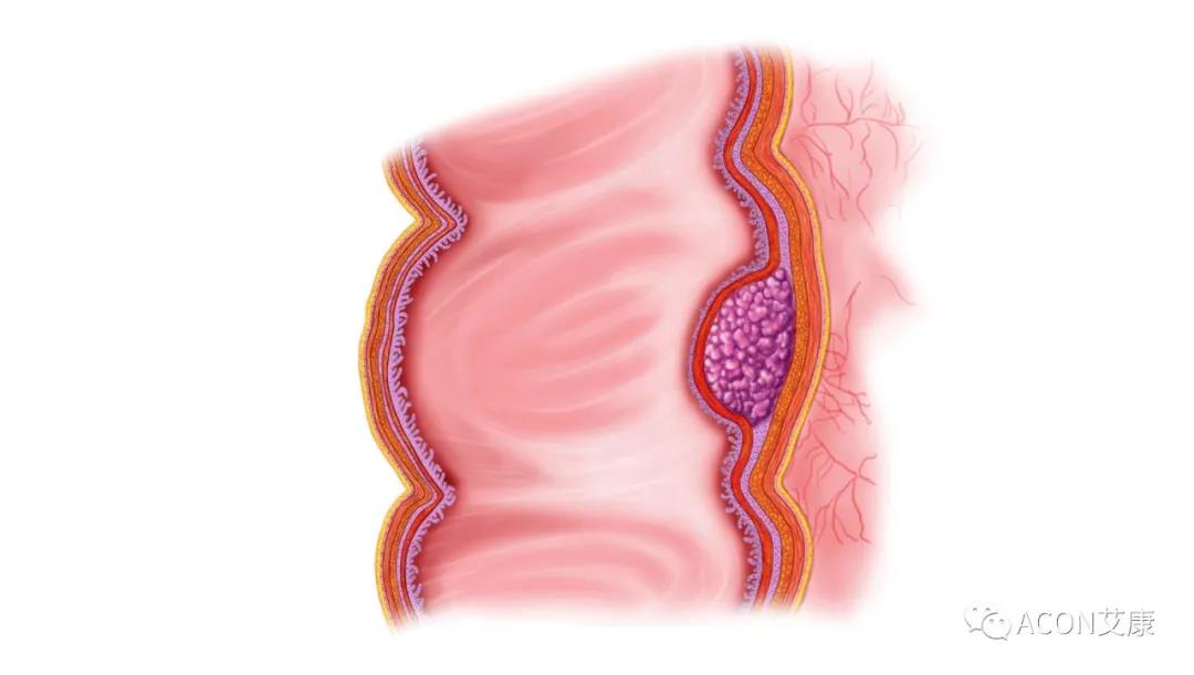 因?yàn)楹鲆暽眢w出現(xiàn)的這些變化，他們最后被確診結(jié)腸癌