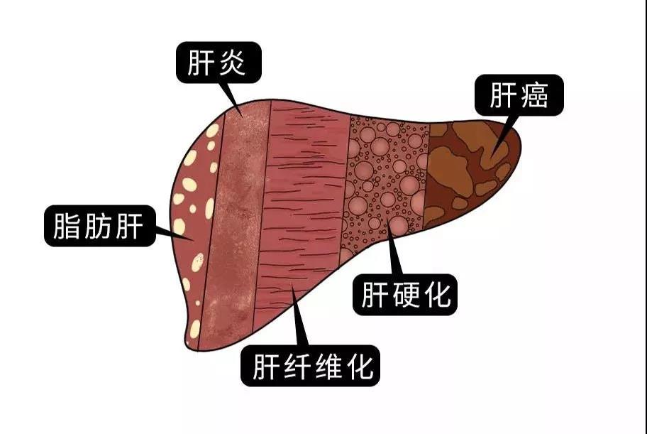 脂肪肝的最大敵人不是肥胖，答案竟是這樣！