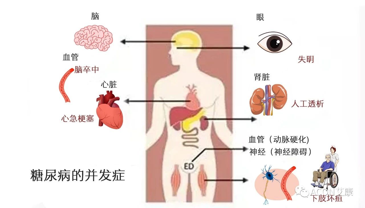 爆上熱搜，因爆發(fā)型糖尿病進入ICU，有哪些教訓值得我們汲取